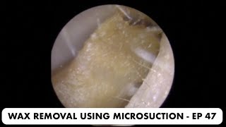 EAR WAX REMOVAL USING MICROSUCTION  EP 47 [upl. by Naejarual934]