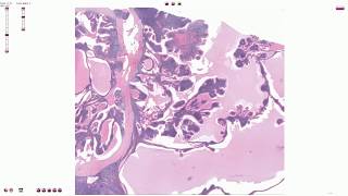 Warthin Tumor  Histopathology [upl. by Bouchier]