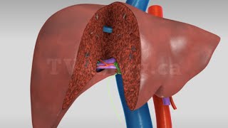 Liver transplant Living donor right hepatectomy donor procedure [upl. by Allemrac]