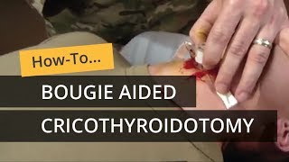 Bougie Aided Cricothyroidotomy [upl. by Anirehc]