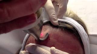 Resurfacing dermabrasion du visage au laser Erbium [upl. by Celina805]