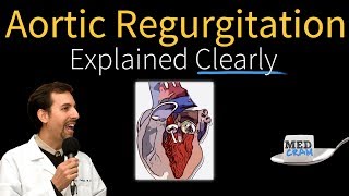 Aortic Valve Replacement Surgery Video [upl. by Kristan]