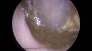 275  Ear Wax Removal Video demonstrating Endoscopic Ear Microsuction E suction® [upl. by Britta41]