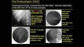 ERCP vs MRCP T tube cholangiogram PTC [upl. by Adnorhs]