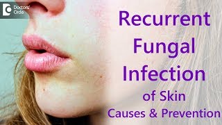 Why do i get recurrent fungal skin infections  Dr Amee Daxini [upl. by Addia]