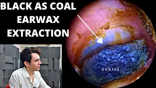 Black As Coal Ear Wax Extracted With Oil And Suction [upl. by Nehemiah]