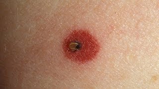 How to Spot Lyme Disease  WebMD [upl. by Aronoh26]