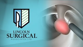 Polyp Removal  Dr Deirdre Hart Colon and Rectal Surgeon  Lincoln Surgical Associates Shiloh IL [upl. by Durkee]