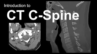 Where are the Cervical Spines Transverse Processes [upl. by Harshman]