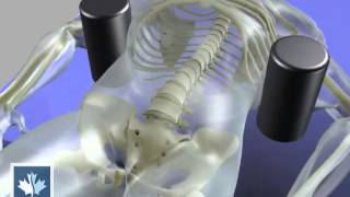 Sciatica  Spinal Decompression  Back Clinics of Canada [upl. by Euqinehs]