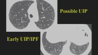 CT imaging and diagnosis of Bronchiectasis [upl. by Pfeffer108]