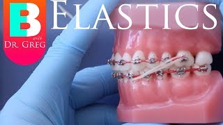 BRACES EXPLAINED Elastics  Rubber Bands [upl. by Yvon]