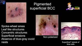 Dermoscopy features associated with subtypes of basal cell carcinomas  Dr Harold S Rabinovitz [upl. by Anaujit]