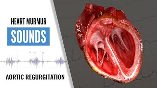 Aortic Regurgitation Key signs in 60 seconds [upl. by Ellga]