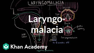 Laryngomalacia  Respiratory system diseases  NCLEXRN  Khan Academy [upl. by Ahtikal]