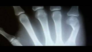 Metacarpal Fracture Symptoms XRay Findings Treatment [upl. by Annawat]