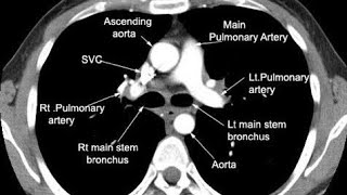 CT Scan Pulmonary Angio PTE protocol [upl. by Zeidman]