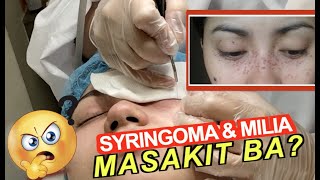 SYRINGOMA amp MILIA REMOVAL MASAKIT BA  Miss Menchie [upl. by Leon]