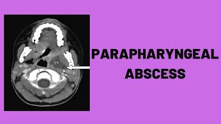 Parapharyngeal Abscess [upl. by Sabrina]