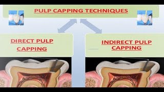 PULP CAPPING Procedure and pulp capping a case report [upl. by Kera]