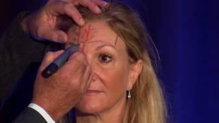 Injectors Anatomy of the Forehead [upl. by Clere]