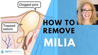 HOW TO REMOVE A MILIA STEP BY STEP  NATURALLY [upl. by Ardnohs]