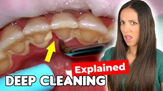 Dental Hygienist Explains Deep Cleaning Procedure [upl. by Yarg]