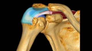 How To Supraspinatus Pathology Case Study Video [upl. by Leola]