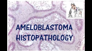 AMELOBLASTOMA HISTOPATHOLOGY I ORAL PATHOLOGY [upl. by Aihsal926]