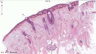 Solar Lentigo  Histopathology [upl. by Mohun]