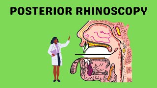 Posterior Rhinoscopy [upl. by Py]