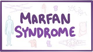 Marfan Syndrome  causes symptoms diagnosis treatment pathology [upl. by Thorman]