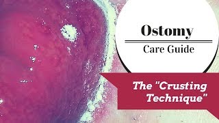 The Ostomy Crusting Technique Explained [upl. by Atteuqahs]