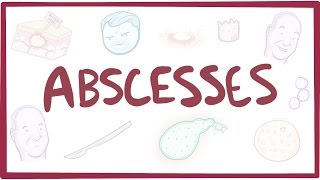 Abscesses  causes symptoms diagnosis treatment pathology [upl. by Lon14]