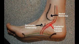 Posterior Tibial Tendinitis Evaluation with Paul Marquis PT [upl. by Airrej]