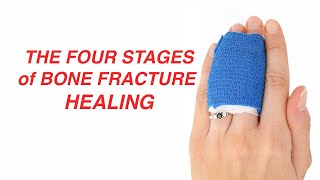 The Four Stages of Bone Fracture Healing [upl. by Ahsemaj]