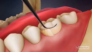 Video Tutorial Dental Scaling [upl. by Nats566]