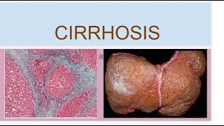 Cirrhosis [upl. by Oiliruam]