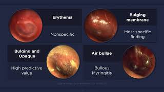 Acute Otitis Media Otoscopic Findings [upl. by Atiuqat]