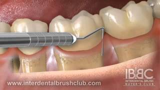 Periodontal disease causes and treatment [upl. by Adlez908]