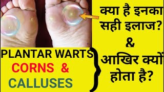 Plantar warts Corns amp Calluses Causes Symptoms amp Treatment [upl. by Jamaal]