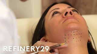 Kybella Double Chin Removal Treatment Up Close  Macro Beauty  Refinery29 [upl. by Tail]