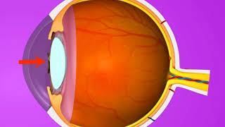 Vision problem Hypermetropia and its correction 3D animation – in English [upl. by Sholem888]