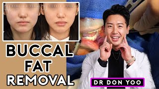 All About Buccal Fat Removal Surgery and Recovery  Dr Donald B Yoo [upl. by Normac]