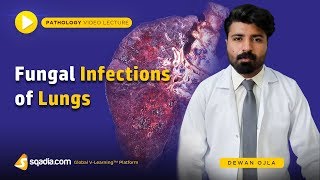 Fungal Infections of Lungs  Actinomycosis Histoplasmosis Coccidioidomycosis  Introduction [upl. by O'Doneven991]