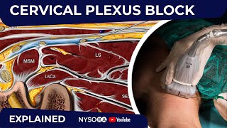 Cervical Plexus Block  Regional anesthesia Crash course with Dr Hadzic [upl. by Jeffry]