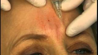 Dr Elliott Shows How to Fill Frown Glabella Lines With A Dermal Filler [upl. by Anatolio]