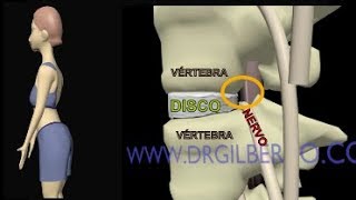 Hernia de Disco  Extrusão Discal  Protusão  Abalamento Dr Gilberto explica [upl. by Edmund]