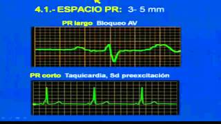 INTERPRETACION DEL ELECTROCARDIOGRAMA [upl. by Cormick]