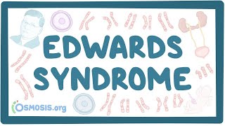 Edwards syndrome  an Osmosis Preview [upl. by Ingunna]